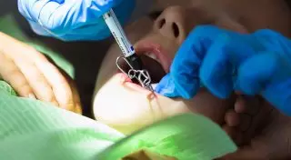 Врач предупредила об опасности кариеса молочных зубов