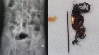 Клок волос и иглу извлекли из кишечника 14-летней девочки в Актау
