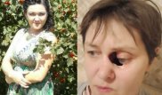 Молодая актюбинка гниет заживо из-за таинственной болезни