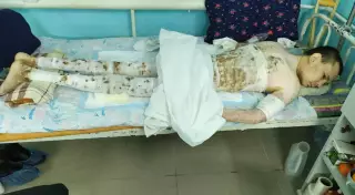 Обгоревший и обманутый герой восемь месяцев лежит в Актобе