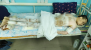 Обманутому герою из Актобе пересадят кожу
