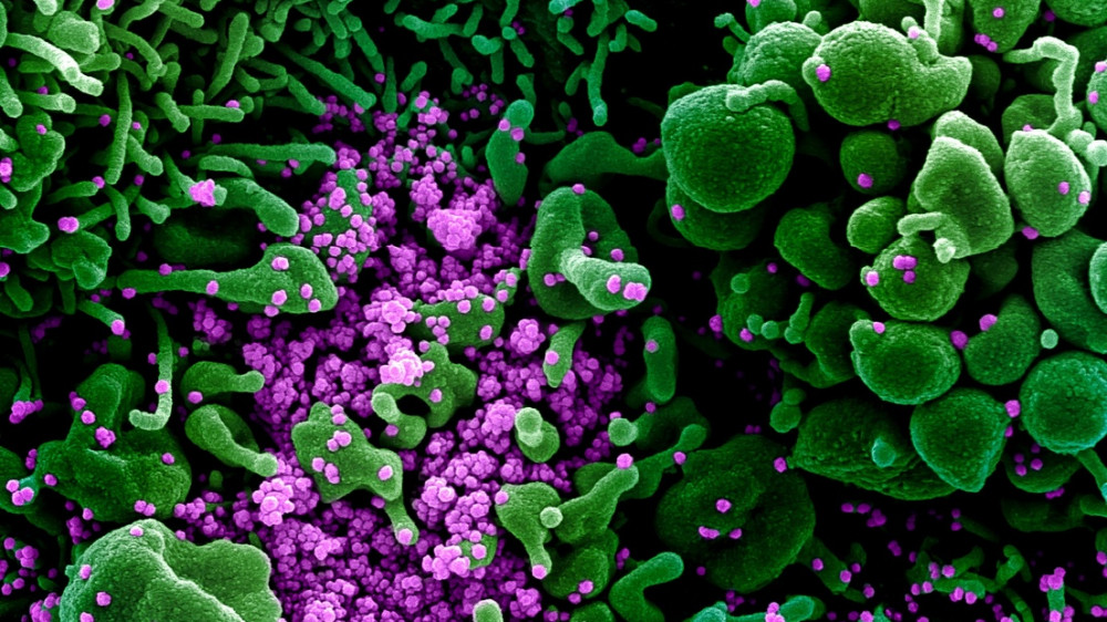 Клетка человека, зараженная вирусом SARS-CoV-2. © NIAID