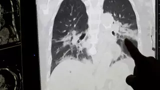 Стали известны результаты вскрытия тел жертв коронавируса