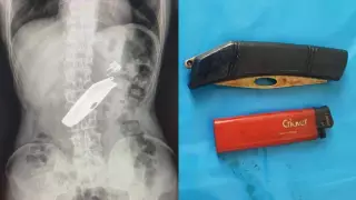 Нож и зажигалку проглотил мужчина в СКО