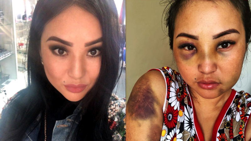 Фото Асель Алкановой до и после избиения. Публикуется с согласия девушки.