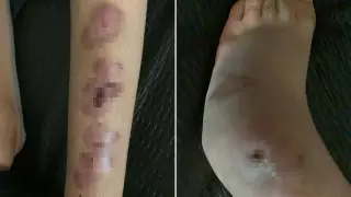 Нога обгорела у ребенка в интернате Туркестанской области