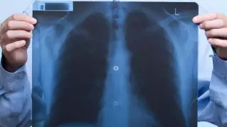 Дәрігер коронавирус инфекциясы өкпені қалай зақымдайтынын түсіндірді