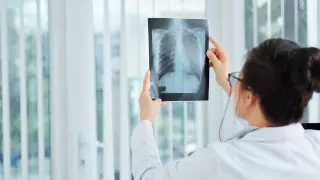 Алматинку с почти полным поражением легких спасли от пневмонии