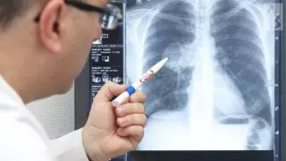 Ауруханаға пневмониямен түсетін науқастар саны 2 есе азайды - Надыров