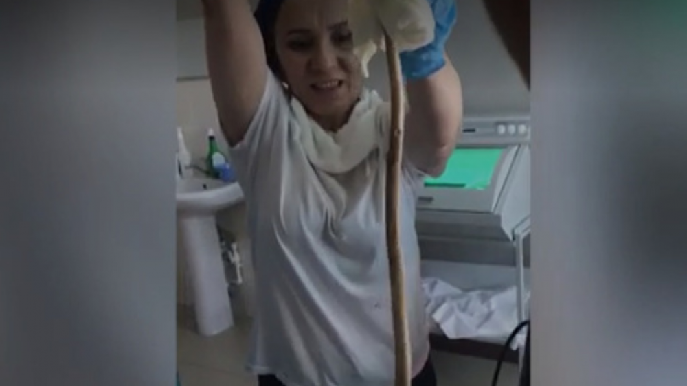 Кадры из операционной: изо рта россиянки извлекли змею