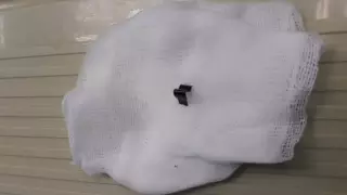 Скрепка едва не лишила алматинца легких