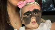 Мама девочки с "маской Бэтмена" показала дочь после операции