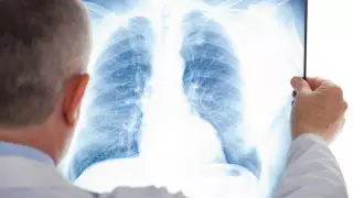 Новых заболевших пневмонией выявили в Казахстане