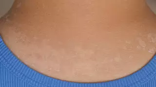 Безобидный симптом оказался признаком онкологии