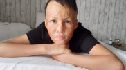 "Хочу новое лицо". Мальчику-художнику из Шымкента сделали операцию в Израиле