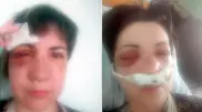 Жительница Сарани лишилась глаза и стала инвалидом после нападения бывшего мужа