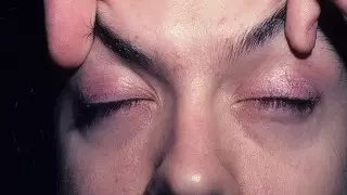 Медики назвали неочевидный симптом развития онкологии в организме