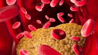 Врач назвал заметные на лице признаки повышенного холестерина