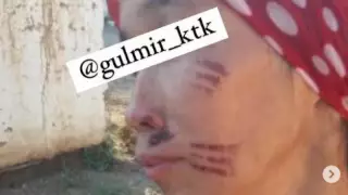 Беті қызған шанышқымен күйдірілген Гүлзираның қазіргі жағдайы қандай?