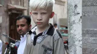 В ООН сообщили о росте убийств людей-альбиносов в пандемию