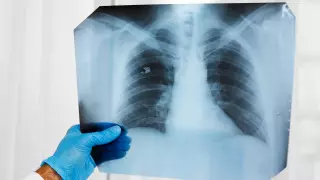 Нейросеть научили определять расу человека по рентген-снимкам