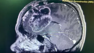 Гигантскую опухоль удалили у пациента врачи из Нур-Султана