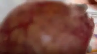 Молодой пациентке вырезали из брюшной полости пятикилограммового паразита