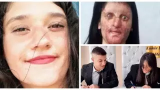 Девушка вышла замуж за парня, облившего ее серной кислотой