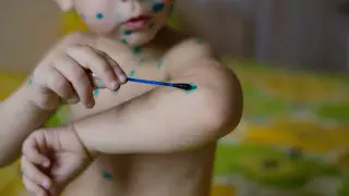 Более 1200 алматинцев переболели ветрянкой с начала года