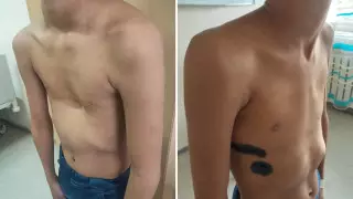 В Алматы успешно прооперировали ребенка с деформацией груди