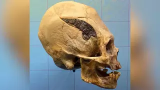 Ученые выявили первую в мире операцию на черепе