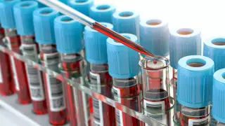 Новый суперштамм ВИЧ обнаружили в Нидерландах