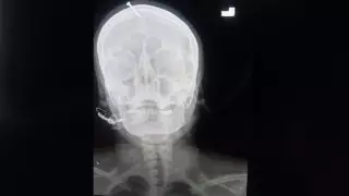 Пакистанка вбила гвоздь в голову, чтобы родить мальчика