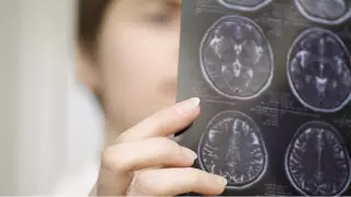 Индийский врач описал случай не прекращающейся 4 месяца икоты у пациента