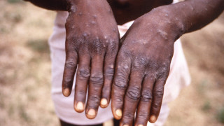Руки пациента с сыпью, вызванной обезьяньей оспой. Фото ©REUTERS