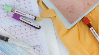 Обезьянья оспа развивается быстрее, чем ожидалось - ученые