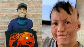 Казахстанцы помогли собрать деньги на новое лицо 15-летнему Абдурахману