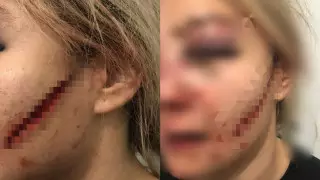 Девушку жестоко избил ее бывший парень близ Талгара