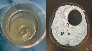 Гигантский эхинококк вытащили из мозга девушки казахстанские нейрохирурги