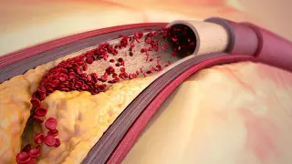 Лучше отказаться: эти продукты провоцируют образование тромбов