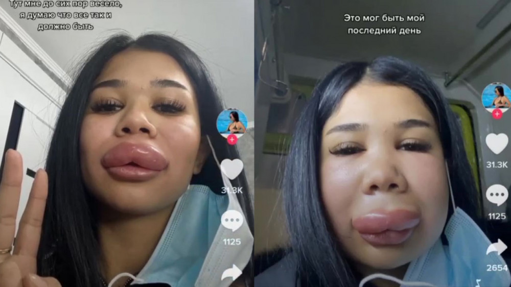Шокирующие последствия после коррекции губ сняла на видео астанчанка