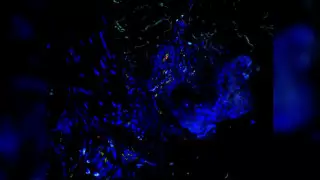 Новое заболевание, вызванное мутациями, выявили врачи