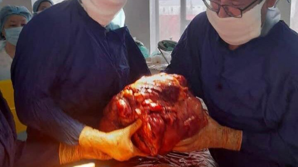 Огромную злокачественную опухоль удалили у пациента в Атырау