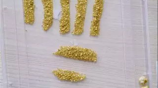 1730 камней извлекли хирурги из желчного пузыря алматинки