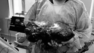 "Плакал от радости". Пациенту вырезали девятикилограммовую опухоль в Шымкенте