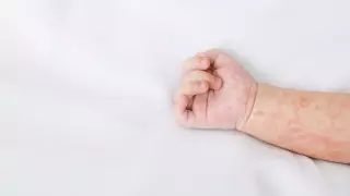 Отказ от вакцинации: в Астане начали регистрировать случаи кори среди детей