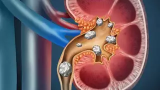6 рекомендаций, которые помогут предотвратить мочекаменную болезнь