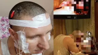 Алматыда ер адам басын ойып, өзіне чип орнатқан: нейрохирург қауіпті операция туралы пікір білдірді