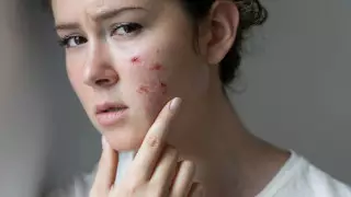 Назван опасный симптом, указывающий на рак кожи