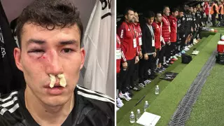 Бахтиеру Зайнутдинову разбили лицо и сломали нос в матче за "Бешикташ"